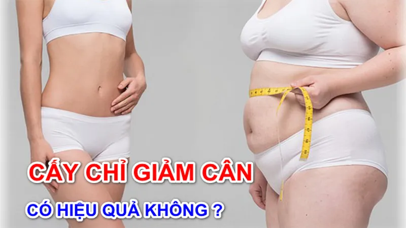 Phương pháp cấy chỉ giảm béo có an toàn không?