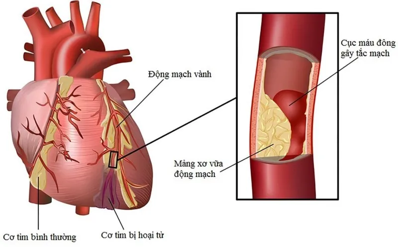 Tìm hiểu 11 cách làm giảm mỡ máu trong 6 tuần hiệu quả